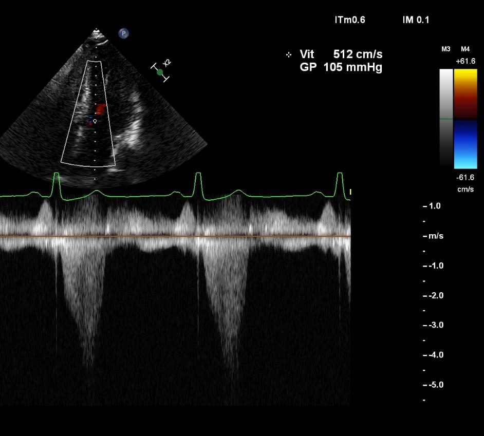 Tracé Doppler continu montrant une enveloppe systolique tardive en poignard, avec une vitesse maximale de 512 cm/s et un gradient de 105 mmHg affichés par l'appareil.