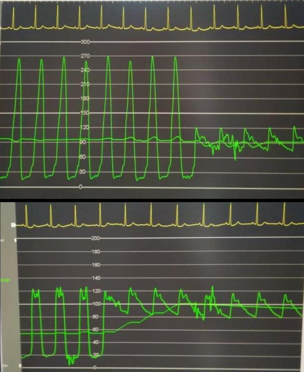 Deux enregistrements de pression superposés, ventricule gauche et aorte avant puis après alcoolisation, montrant la disparition du gradient au retrait du cathéter.