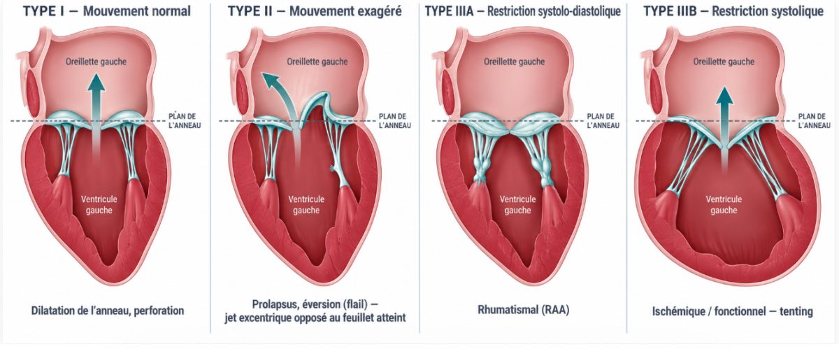 Schéma comparatif en quatre panneaux illustrant le type I (mouvement normal, dilatation d'anneau ou perforation), le type II (mouvement exagéré, prolapsus), et les types IIIA et IIIB (mouvement restrictif rhumatismal puis ischémique).